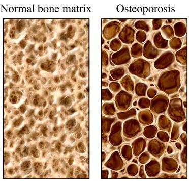 Osteoporosis Depletion Disease of Bone