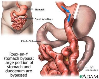 obesity-surgery