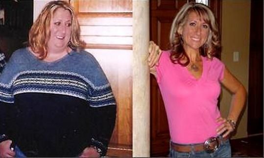 The Ugly Truth Behind Weight Loss Surgery surgical weight management