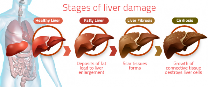 Fatty Lliver Disease Stages of Liver Damage