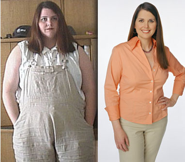 LAPBAND weight loss surgery before after photo images picture