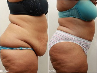 Weight loss surgery results before after