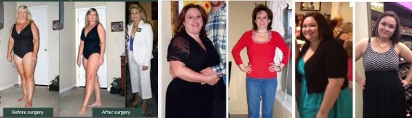 Gastric sleeve surgery fast weight loss results success