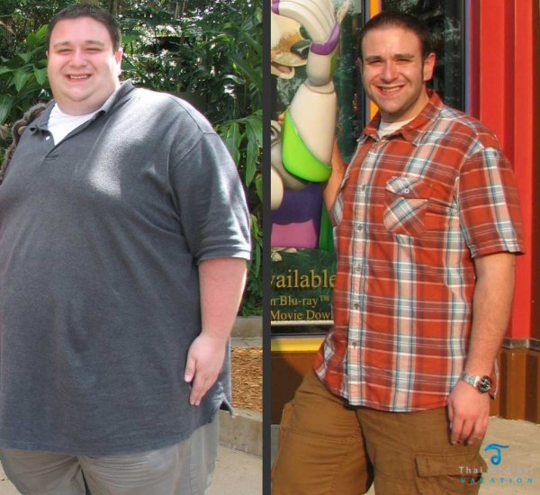 An amazing Weightloss surgery result