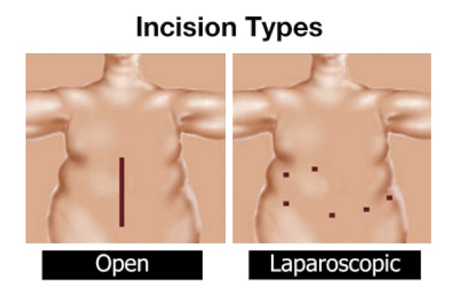 Laparoscopic Weight Loss Surgical Procedure