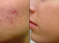 Reflexology for Acne: Effective Treatment