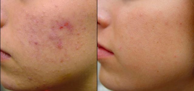 Reflexology for Acne: Effective Treatment