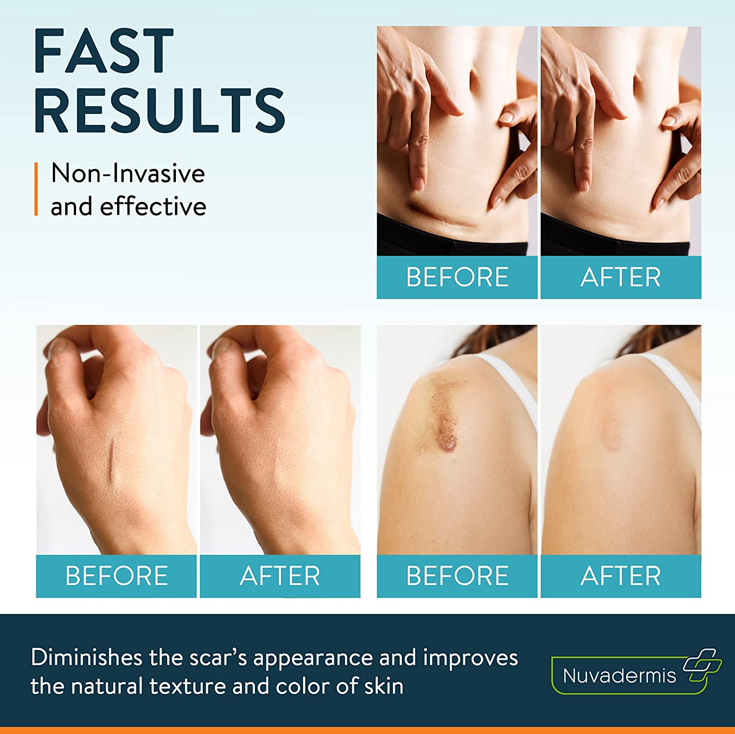 Silicone Scar Removal Sheets by NUVADERMIS is a Non-invasive and Effective Skin Scar Treatment