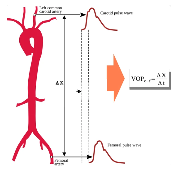 Pulse Wave Velocity (PWV)